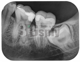 Fire CR Dental X-Ray Reader